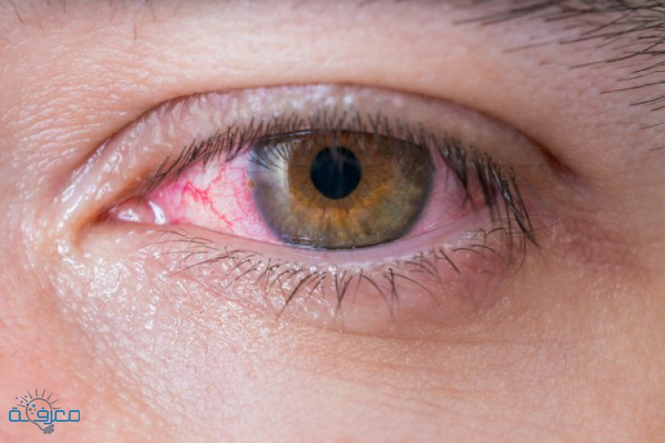 أسباب حساسية العين وكيفية علاجها