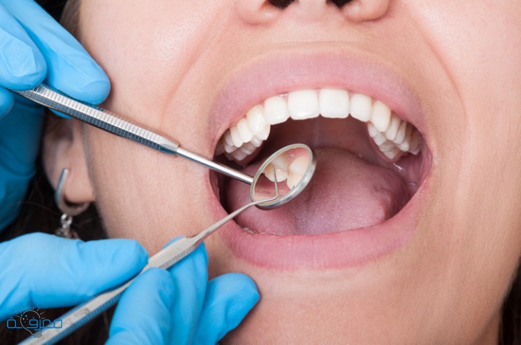 أسباب تسوس الأسنان وطرق العلاج